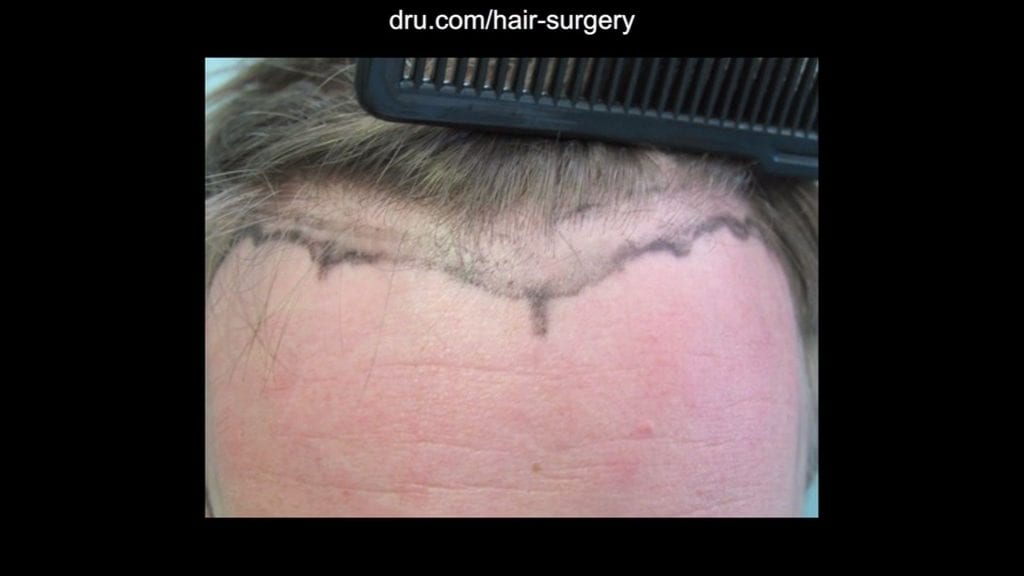 Dr. Umar worked to develop the preferred look with the patient.