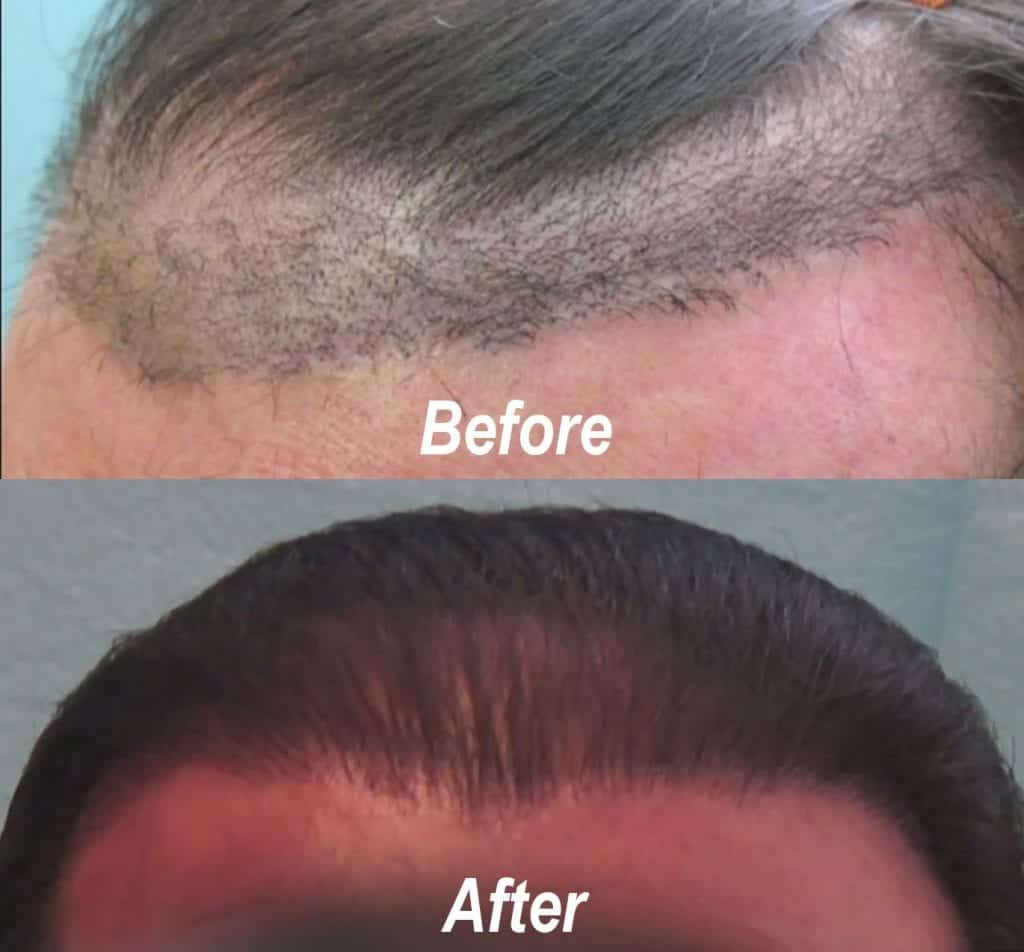 Juri Flap Surgery Problems Fixed- Before and After repair using the Dr.UGraft* Juri Flap Surgery Problems Fixed- Before and After repair using the Dr.UGraft*