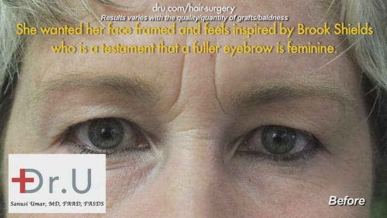 Before Eyebrow Hair Loss Treatment: Loss of hair before Dr.UGraft 