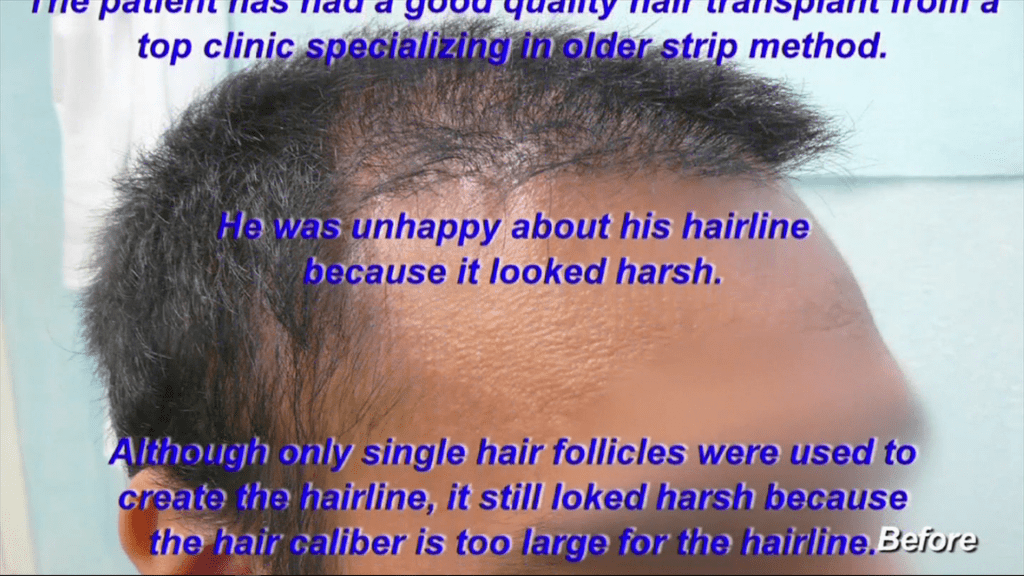 Previous surgery left a harsh hairline Previous surgery left a harsh hairline
