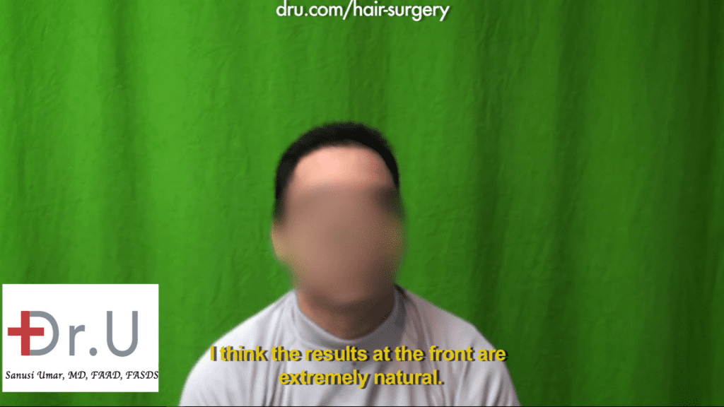 Hairline hair transplant: The patient received excellent results from the 1000 Dr.UGrafts repair of hairline after previous strip surgery. Hairline hair transplant: The patient received excellent results from the 1000 Dr.UGrafts repair of hairline after previous strip surgery.