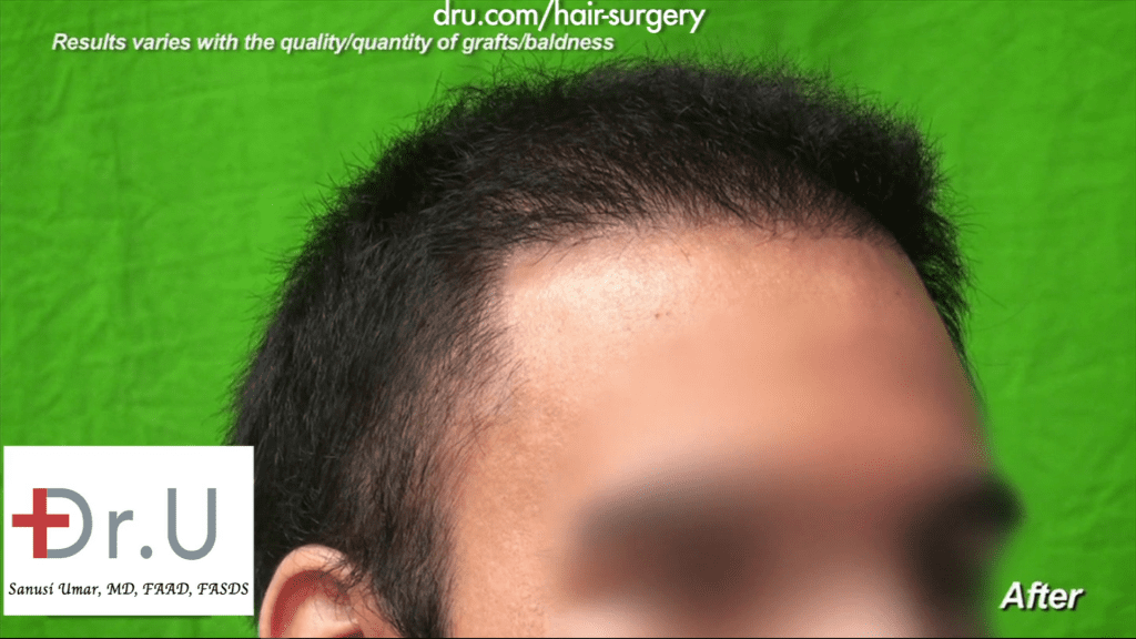 Hair transplant hairline design: The hairline now has a natural flow Hair transplant hairline design: The hairline now has a natural flow