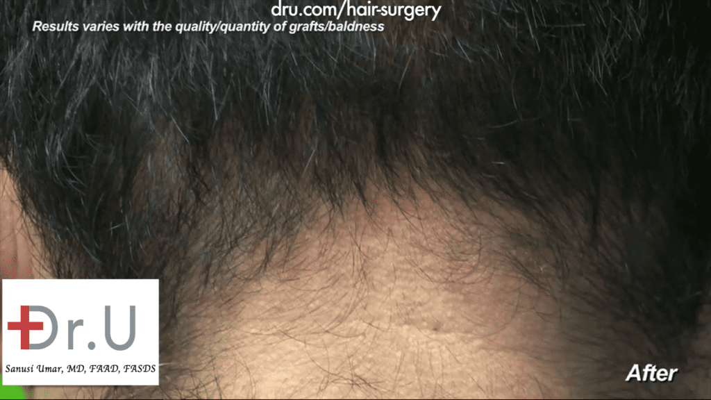 Hairline transplant: The nape of the patient has healed properly while growing back and showing no visible sign of the 1000 Dr.UGraft repair of hairline after previous strip surgery performed by Dr. Umar Hairline transplant: The nape of the patient has healed properly while growing back and showing no visible sign of the 1000 Dr.UGraft repair of hairline after previous strip surgery performed by Dr. Umar