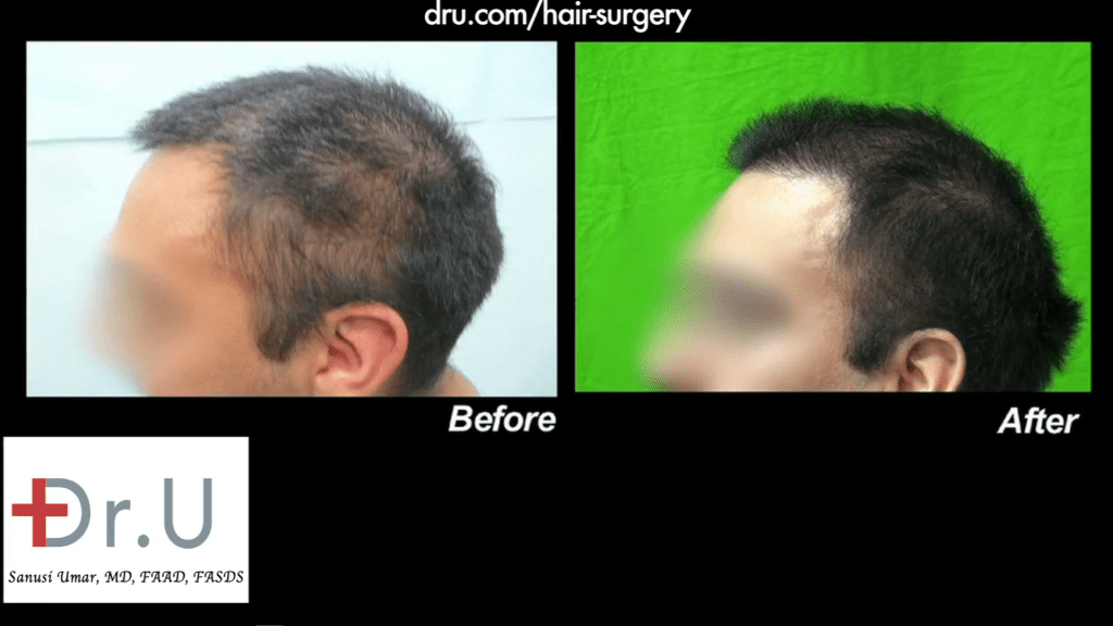 Hairline Repair Using Nape hair - Frontal Hair Transplant Before and After Photo Hairline Repair Using Nape hair - Frontal Hair Transplant Before and After Photo