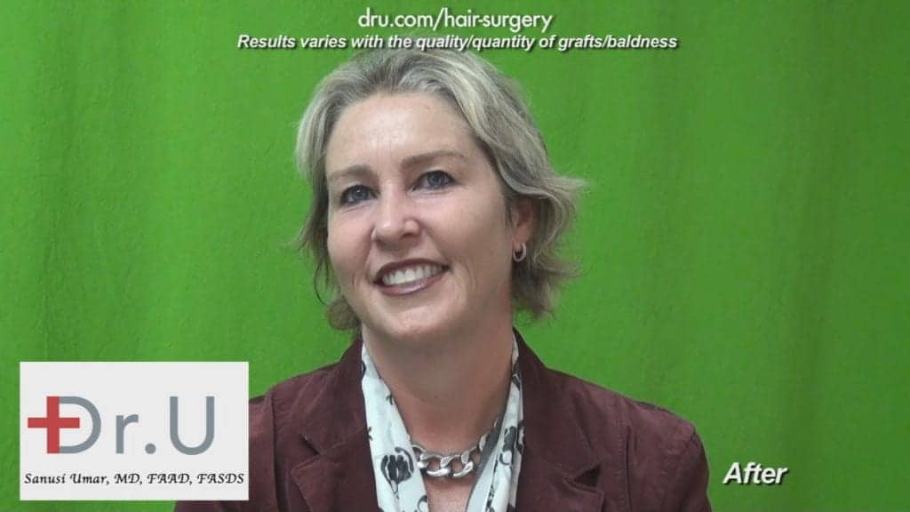 Dr UGraft Surgery For Eyebrow Hair Loss Treatment Achieves Brook Shields Eyebrow Look