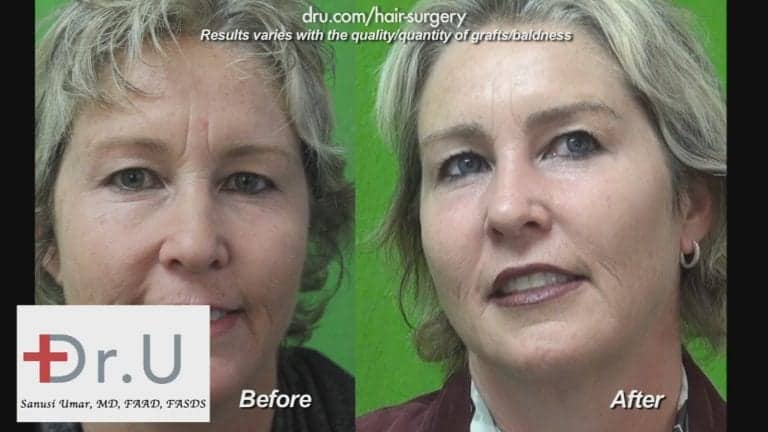 How to get thick eyebrows: Before and After Eyebrow Hair Transplant