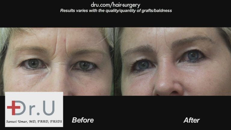 Help for thinning eyebrows: The Dr.UGraft offer's Eyebrow loss solutions