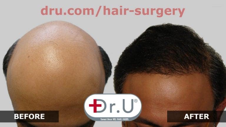 Change your identity by NW7 full hair restoration.