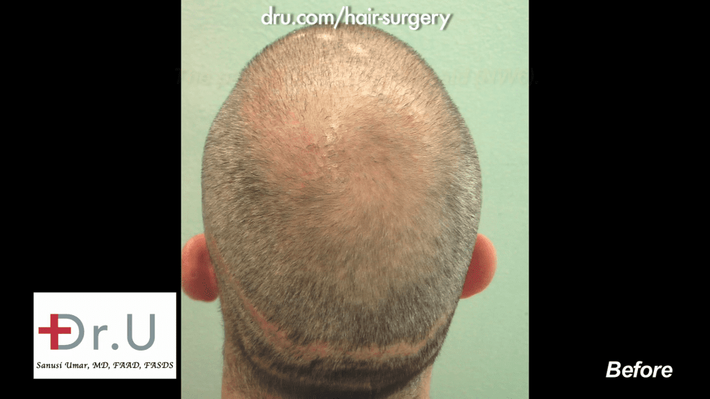 NW6 Baldness prior to being corrected with 13,500 Grafts