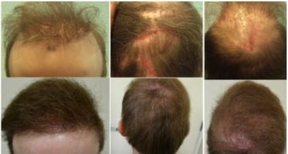 Patient's prior procedure required the best hair transplant repair doctor in the world Patient's prior procedure required the best hair transplant repair doctor in the world