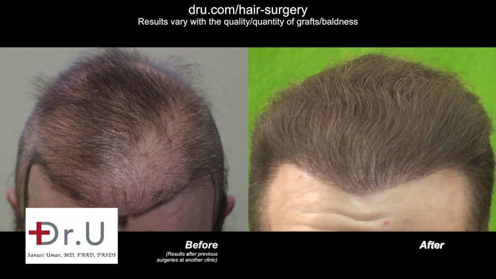 Best Corrective Hair Surgery Doctor in the World: Dr. Umar restored this patient's hairline and repaired scarring from a previous procedure Best Corrective Hair Surgery Doctor in the World: Dr. Umar restored this patient's hairline and repaired scarring from a previous procedure