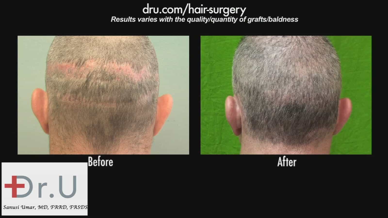 FUT (Follicular Unit Transfer) - also known as Follicular Unit Extraction - Used for strip scar repair