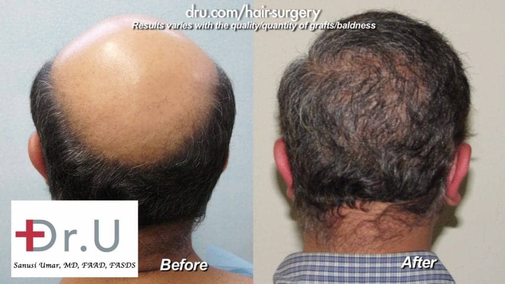 Beard transplant before and after: Patient who suffered from severe hair loss received FUE beard and body hair transplantation from Dr. Umar's advanced Dr.UGraft BHT method.* Beard transplant before and after: Patient who suffered from severe hair loss received FUE beard and body hair transplantation from Dr. Umar's advanced Dr.UGraft BHT method.*