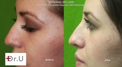Nose enhancement without surgery before and after Nose enhancement without surgery before and after