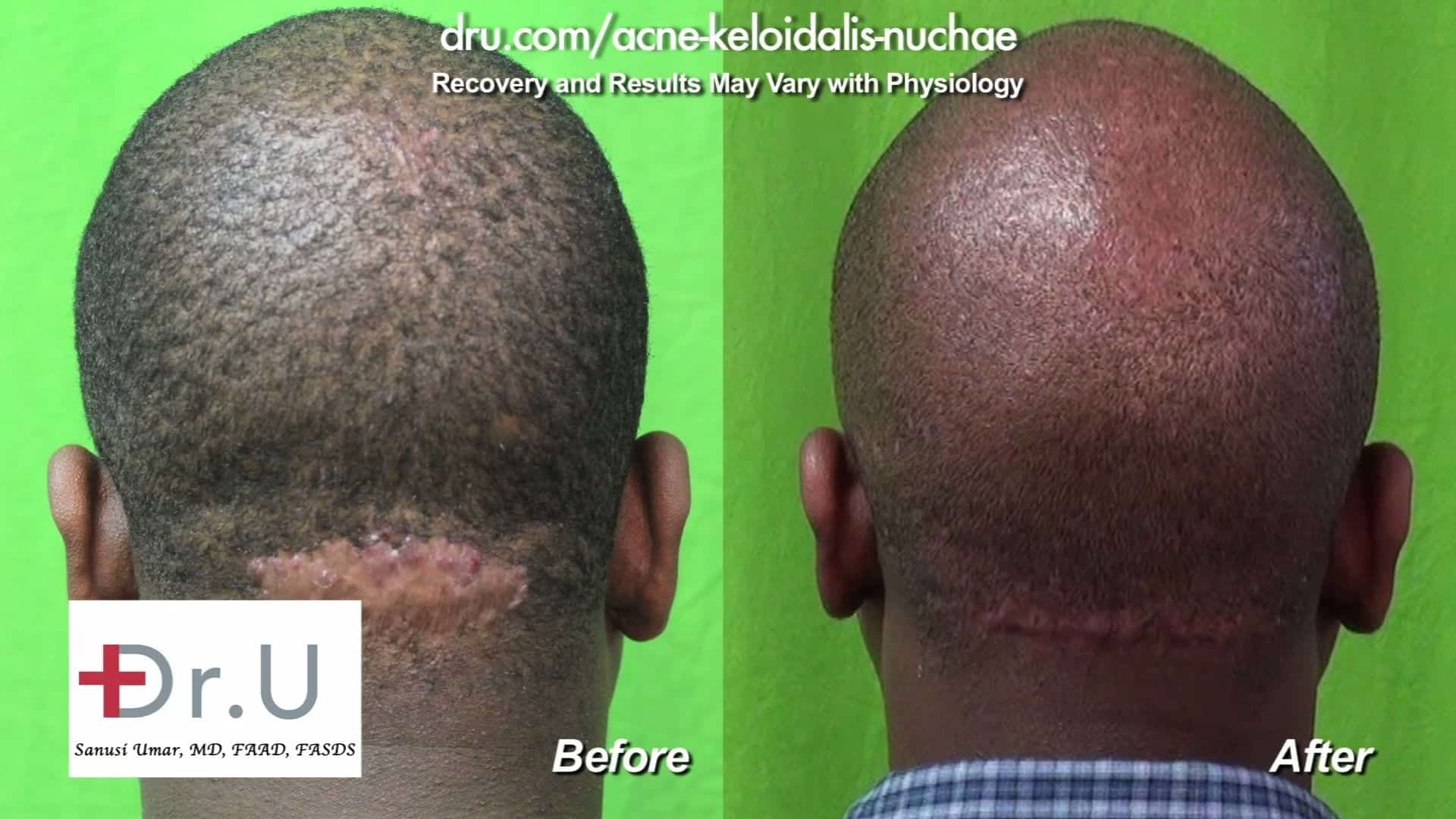Scar Revision UK