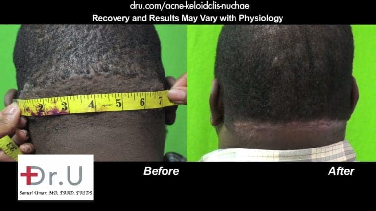 Dr U AKN Surgical Excision of Lesion Treatment Results
