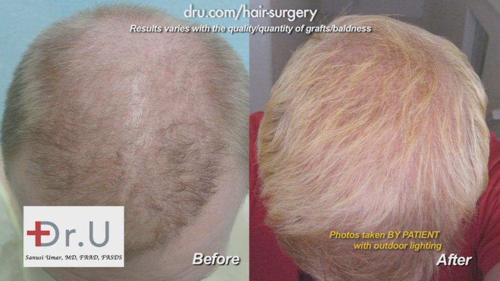 Before and after DrUGraft: fix asymmetric hairline
