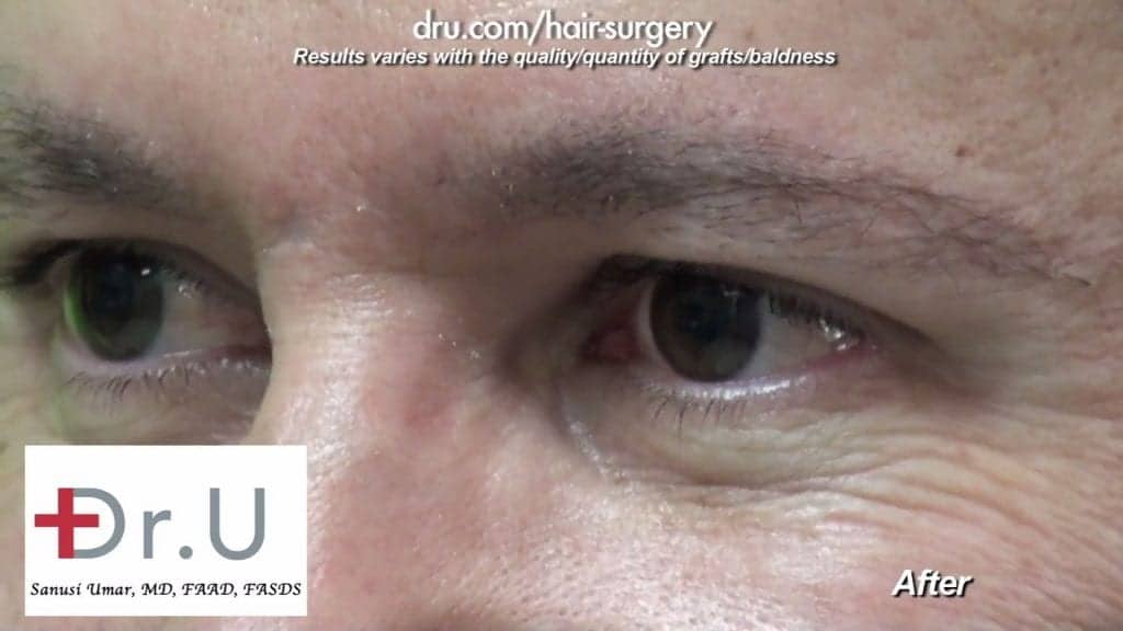 Male eyebrow restoration after Dr.Graft surgery. Eyebrow hair transplant cost depends on the number of grafts needed