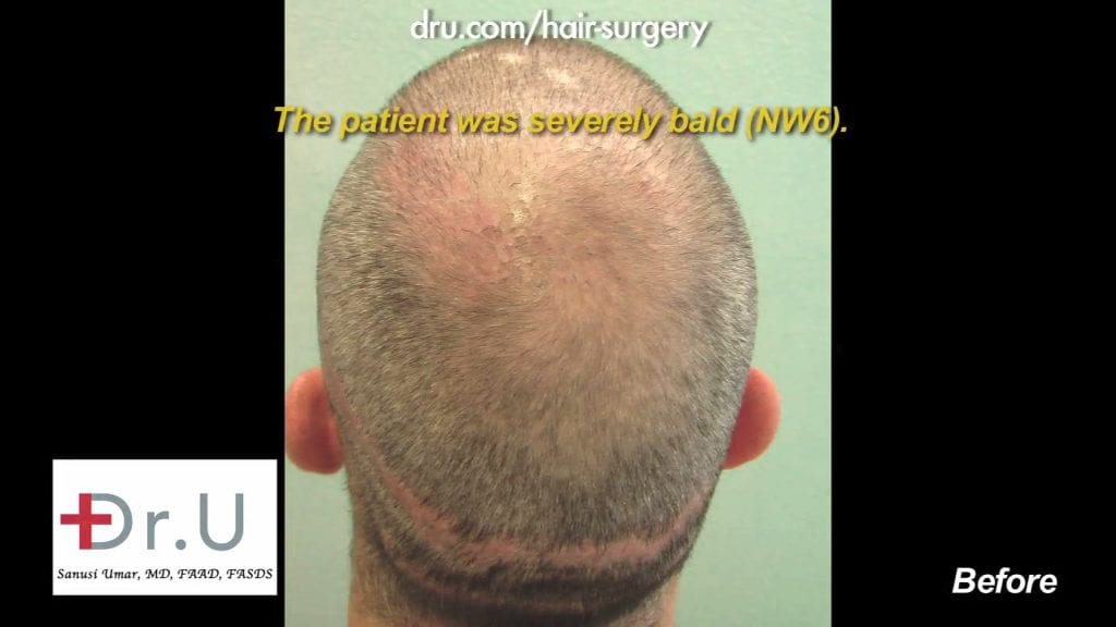 This patient was a 6 on the NW scale, he came to Dr. Umar to fix this.