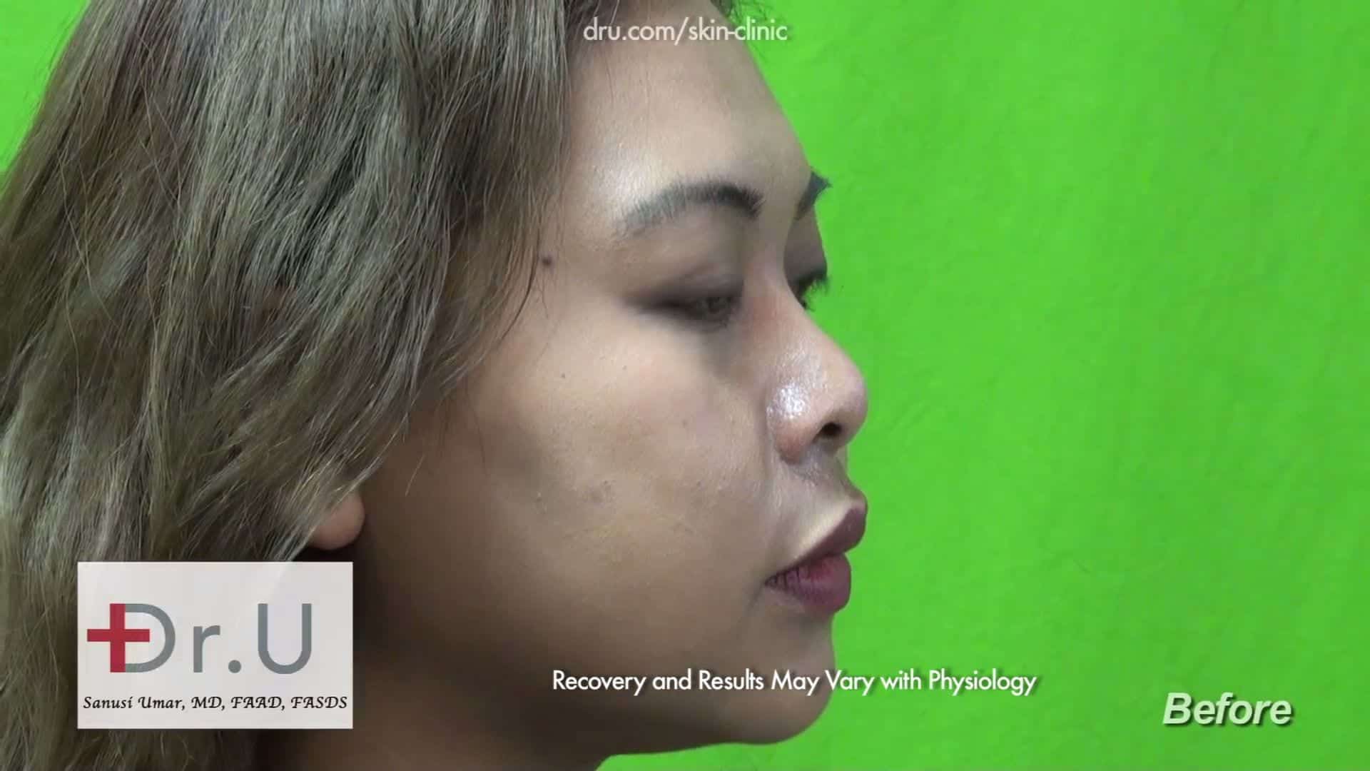 A candidate for non surgical nose job Before Radiesse nose filler was used