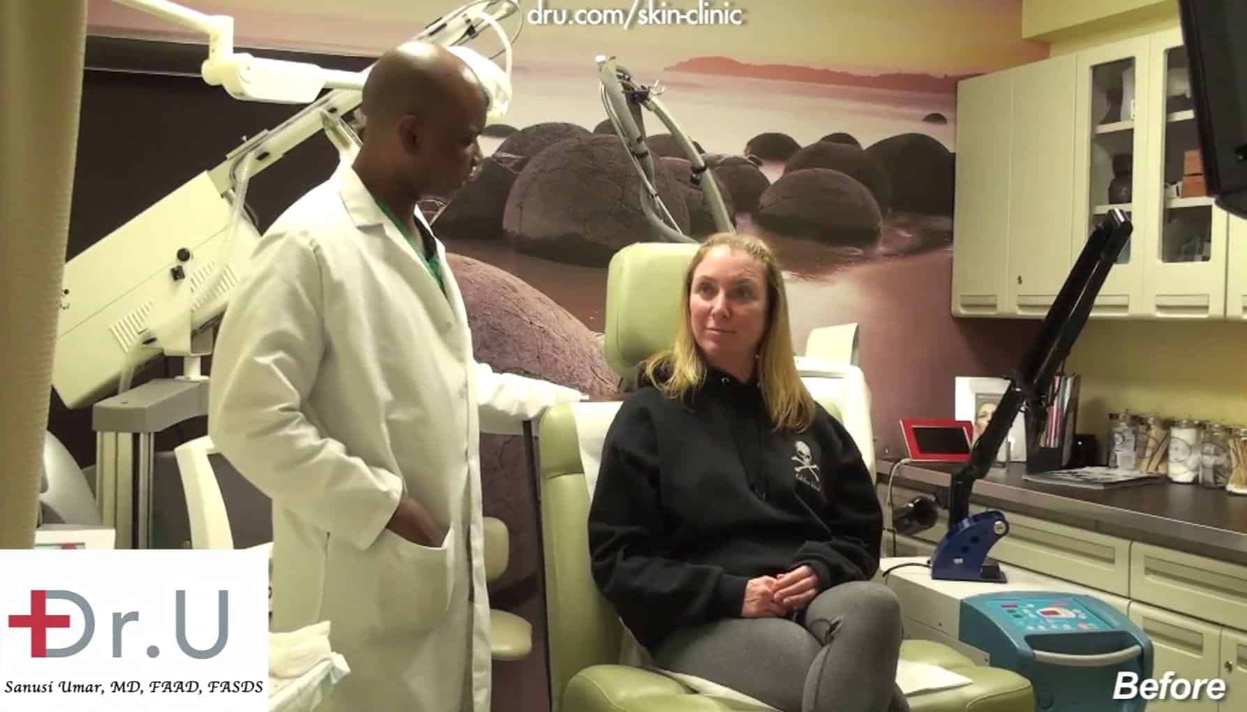 During your consultation you will discuss if you are a good candidate for the laser spectra.*