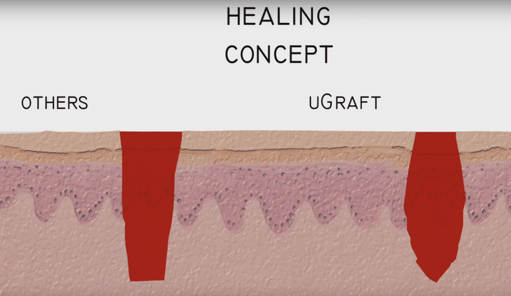 FUE wound healing: Generally, wounds from the DrUGraft heal in about a month