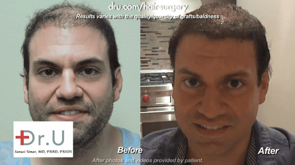 Here you can see the improved coverage the patient has after being treated with the Dr. Ugraft. * Here you can see the improved coverage the patient has after being treated with the Dr. Ugraft. *