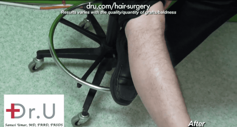 This patient's male eyebrow restoration with leg donor hair shows excellent healing results with no obvious or visible signs of scarring This patient's male eyebrow restoration with leg donor hair shows excellent healing results with no obvious or visible signs of scarring