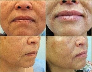 Lip enhancement before and after
