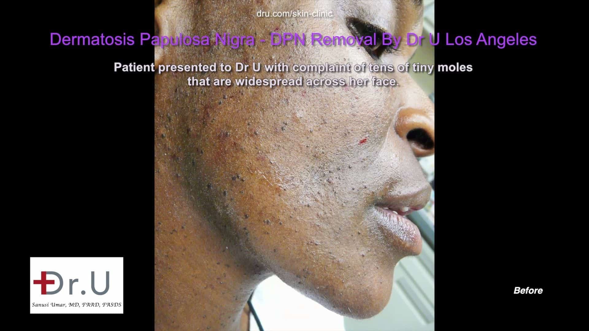 Patient before her DPN treatment Patient before her DPN treatment