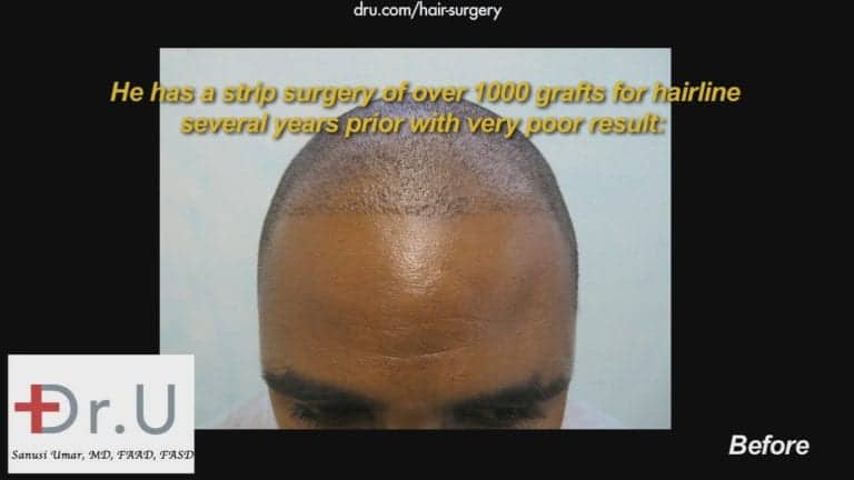 Receding hairlines in black men should be treated with specialized tools to help ensure the best yield possible. This African American patient did not experience the growth he wanted