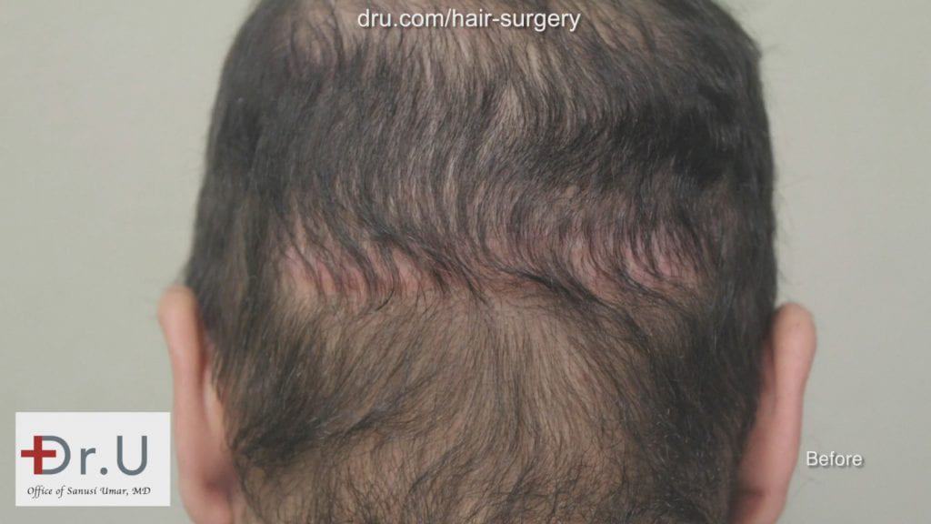 Photo showing patient before his hair transplant reparative surgery with Dr. Umar showing the linear hair restoration scar left behind from a previous procedure.