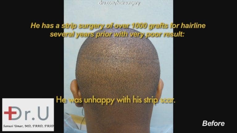 Strip hair transplantation for African Americans is often not compatible with the fact that many men of this demographic prefer very short hair styles. Therefore, linear scars are extremely visible 