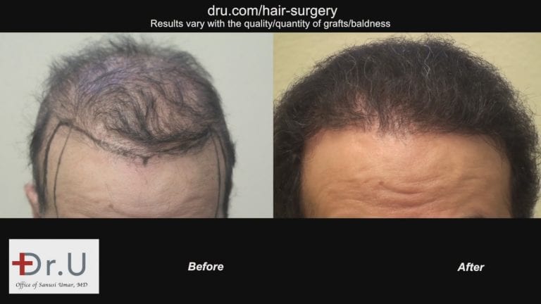  Dr.Umar restores entire head of hair using 1100 grafts taken from the scalp and the body. 
