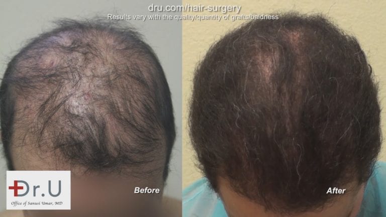 Before and after a Dr.UGraft hair transplant repair using 1100 donor grafts of body and head hair.