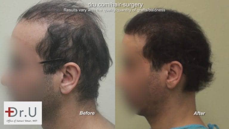 The Dr.UGraft can reverse the results of a poor hair transplant. This patient's case used body hair grafts for his bad hair transplant repair procedure