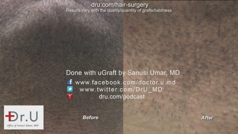The Dr.UGraft™ left behind no visible hair restoration scar remains at the beard donor area