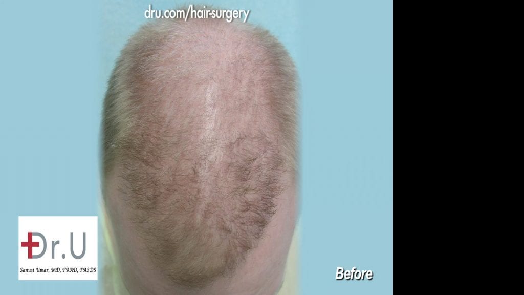 After hair transplant at another clinic, the patient was left with an asymmetric hairline and frontal scalp