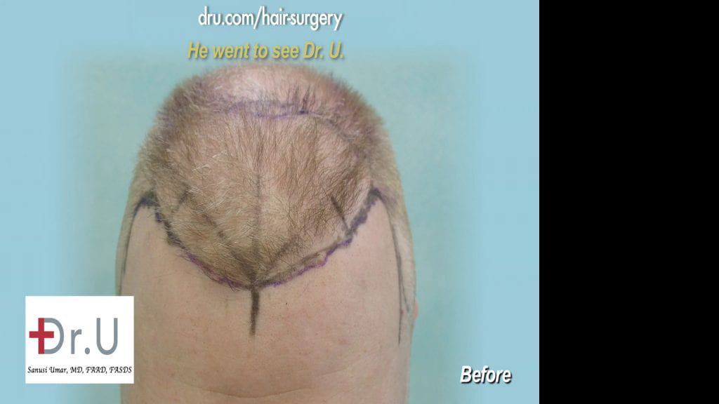 Before each procedure Dr. U maps out where the hair needs to be extracted.