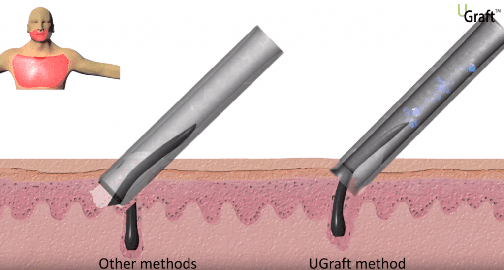How Dr.UGraft technology extracts beard hair grafts for more coverage * How Dr.UGraft technology extracts beard hair grafts for more coverage