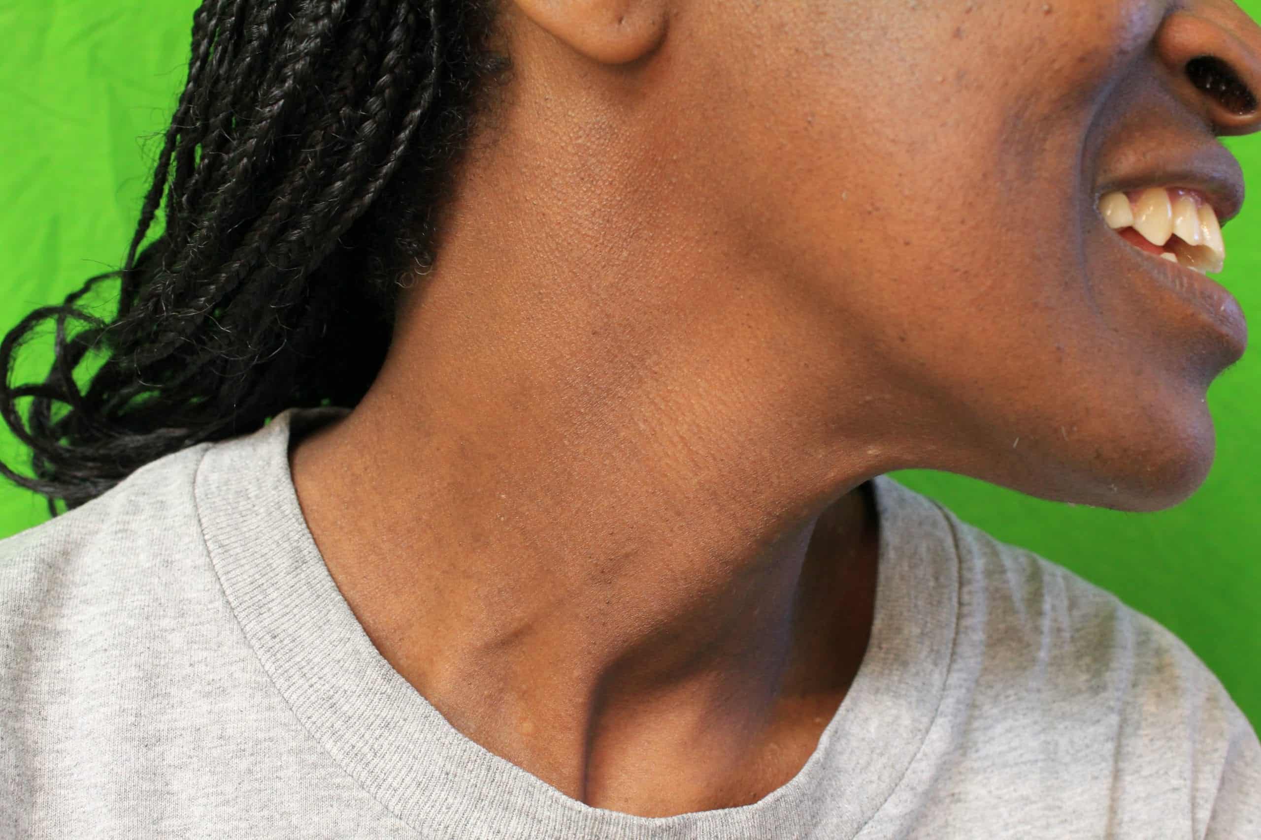 What happens after DPN removal healing What happens after DPN removal healing