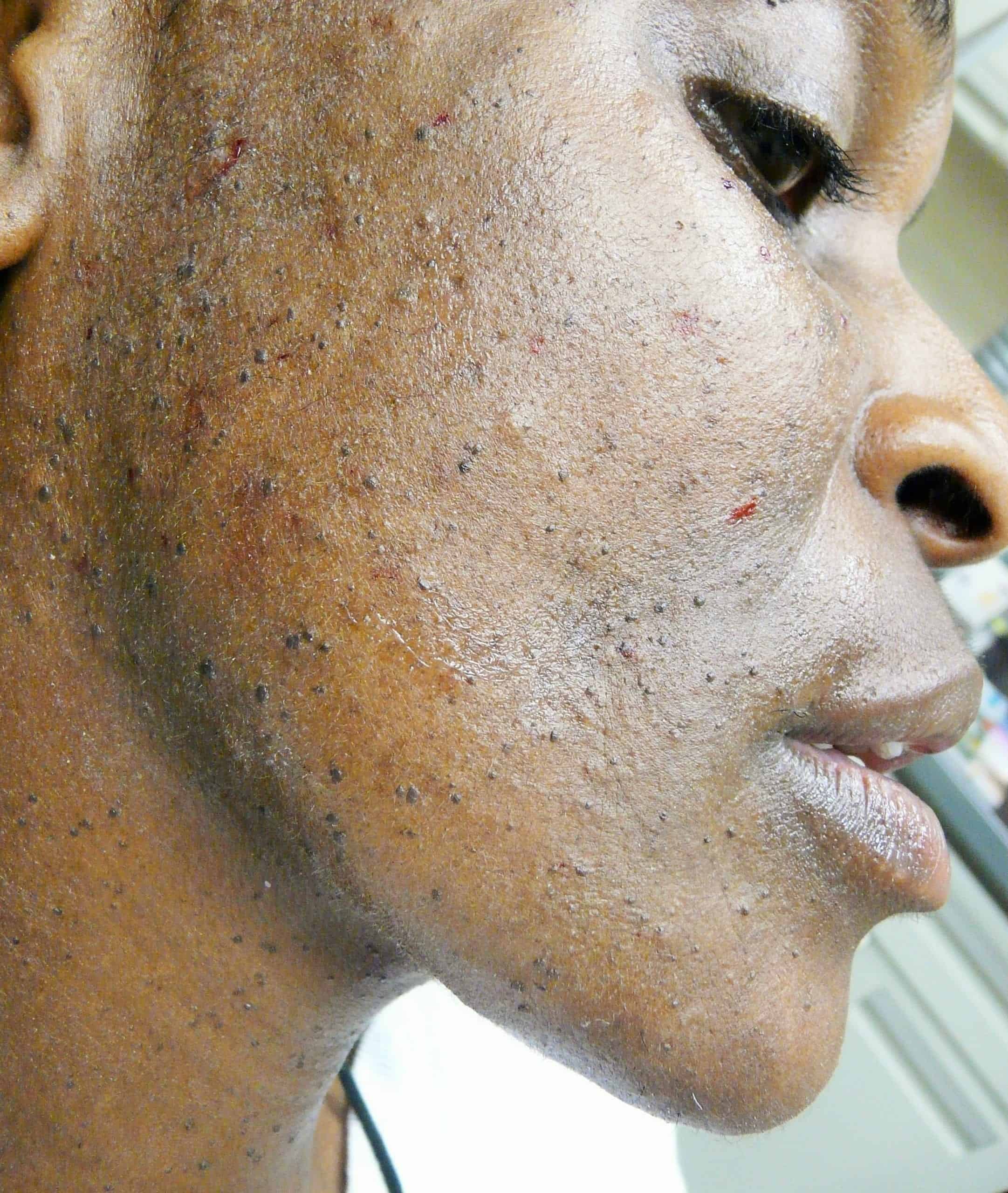 Photo showing lack of DPN skin prevention Photo showing lack of DPN skin prevention