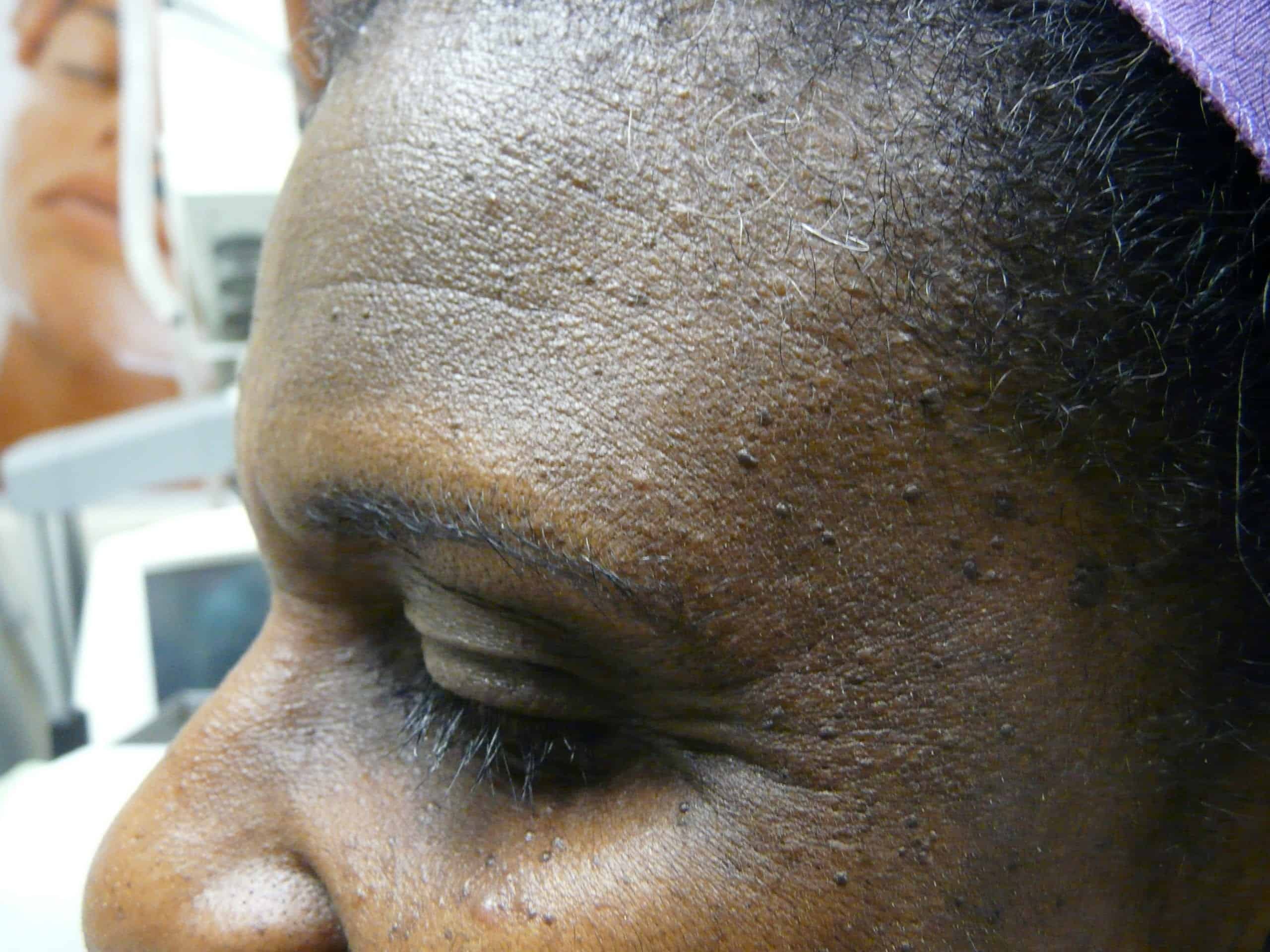 An example of DPN skin causes An example of DPN skin causes