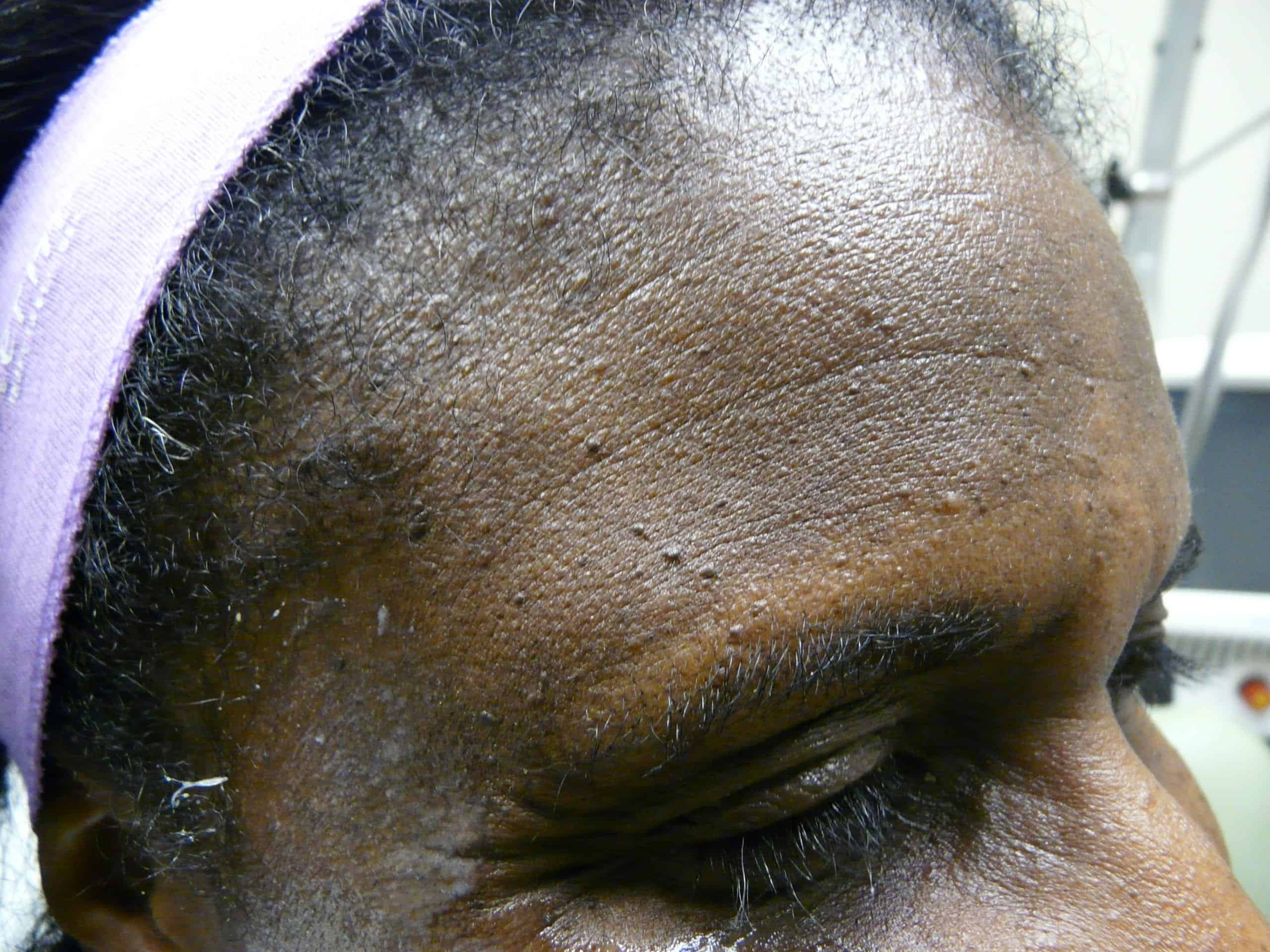 DPN removal before treatment with Dr. Umar. DPN removal before treatment with Dr. Umar.