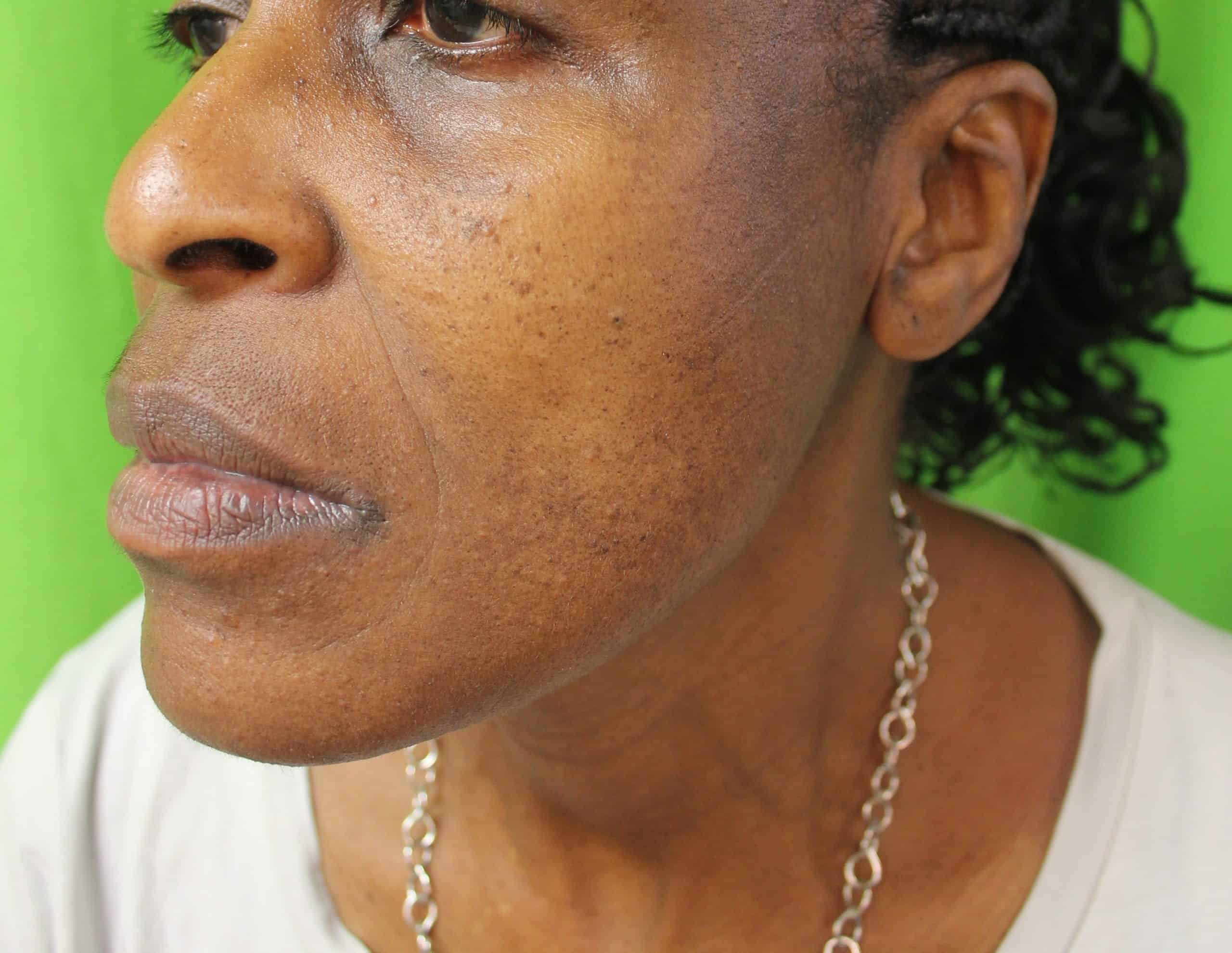 DPN removal before and after with this being the after. DPN removal before and after with this being the after.