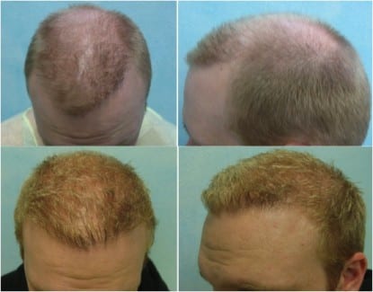 Hair Transplant Tourism is Not Cheaper in the long run: This California patient received an FUE treatment in another country to save cost elsewhere and it resulted in a uneven hairline and continued loss of hair. He then had it fixed by Dr. Umar in Los Angeles Hair Transplant Tourism is Not Cheaper in the long run: This California patient received an FUE treatment in India to save cost elsewhere and it resulted in a uneven hairline and continued loss of hair. He then had it fixed by Dr. Umar in Los Angeles