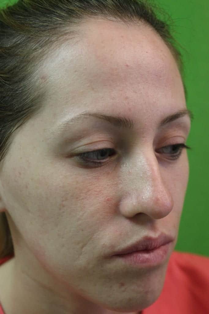 A young patient of Dr U in Manhattan Beach Los Angeles who presented with complaint of laugh line wrinkles