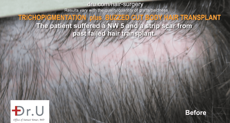 The patient before Dr.UGraft FUE Plus SMP.