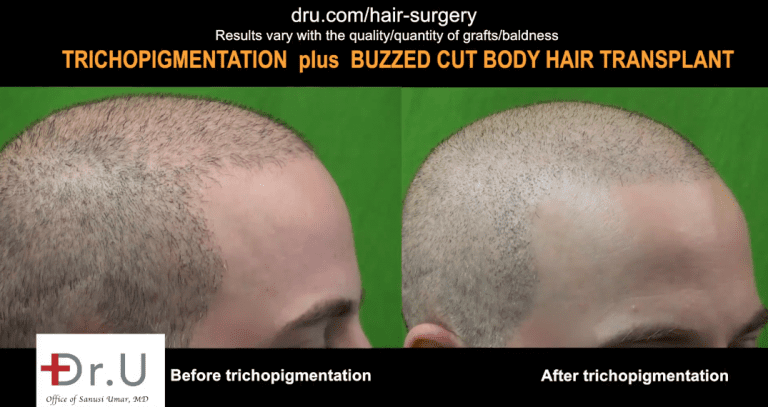 Incredible results of SMP after FUE hair transplant.