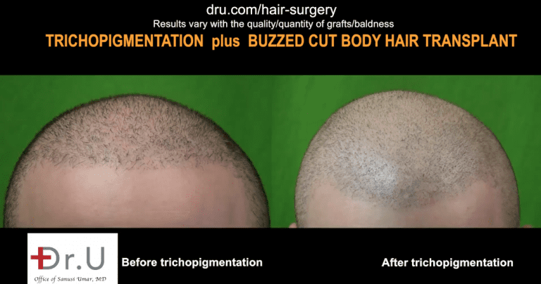 SMP affect hair transplant success